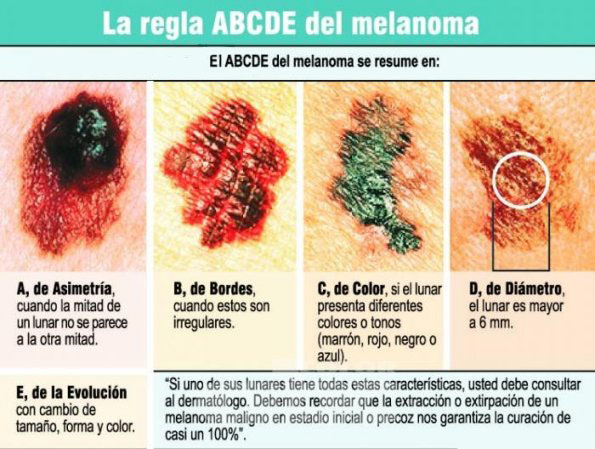 Ejemplo de Lunares Benignos y No Benigno